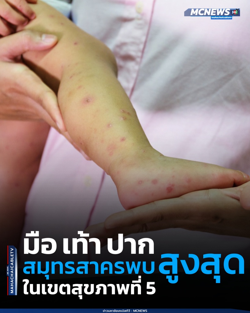 มือเท้าปาก1 copy